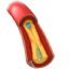 Angioplasty | Dr. Gokhale