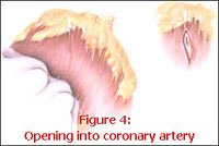 location of coronary artery openings