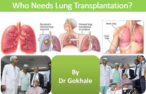 WHO NEEDS LUNG TRANSPLANTATION?