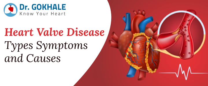 Heart Valve Disease Types Symptoms and Causes