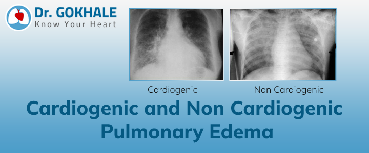 Cardiogenic and Non Cardiogenic Pulmonary Edema