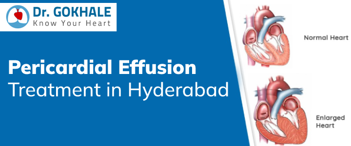 Pericardial Effusion Treatment in Hyderabad | Dr Gokhale