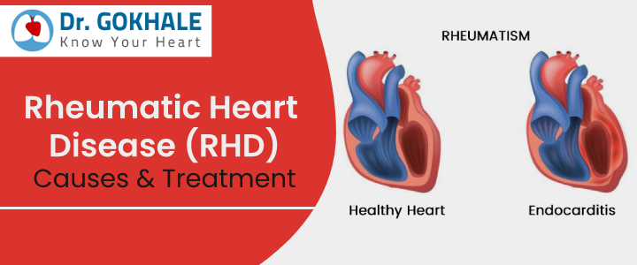 Rheumatic Heart Disease (RHD) Causes & Treatment