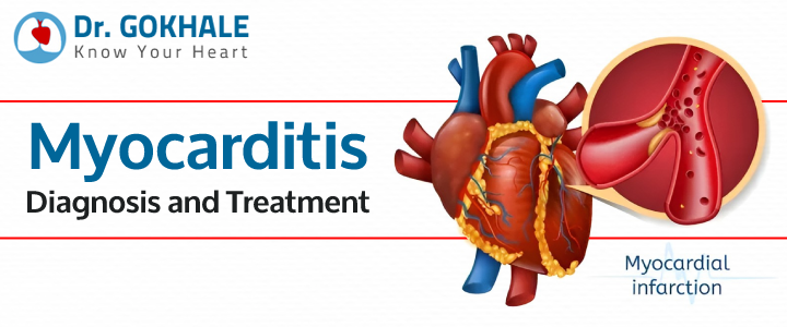 Myocarditis Diagnosis and Treatment