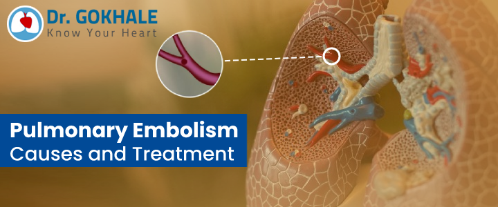 Pulmonary Embolism Causes and Treatment | Dr Gokhale