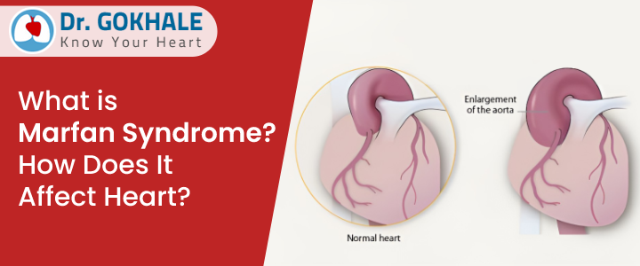 What is Marfan Syndrome? How Does It Affect Heart?