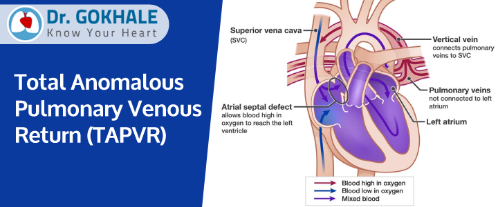 Total Anomalous Pulmonary Venous Return (TAPVR)