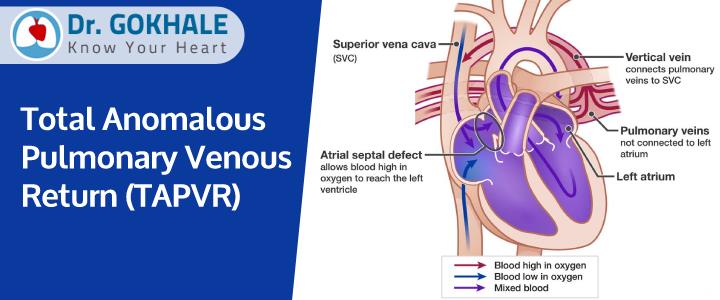 Total Anomalous Pulmonary Venous Return (TAPVR) | Dr Gokhale