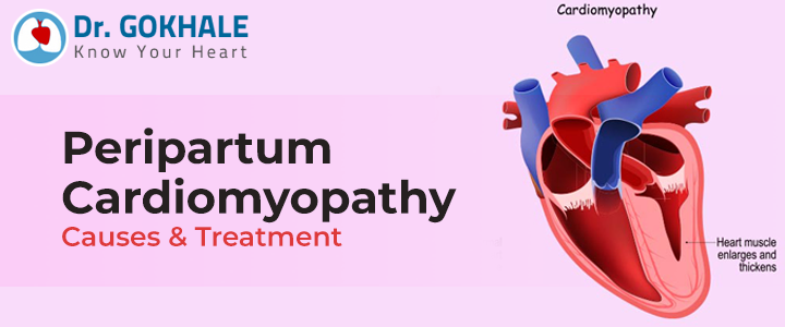 Peripartum Cardiomyopathy Causes & Treatment
