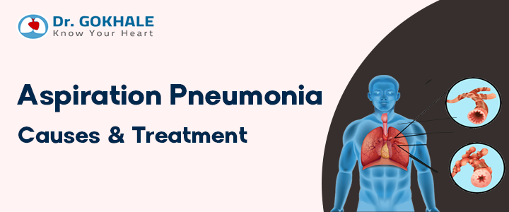 Aspiration Pneumonia Causes & Treatment in Hyderabad