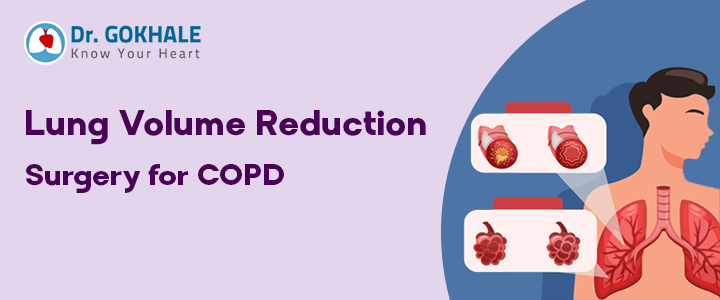 Lung Volume Reduction Surgery for COPD
