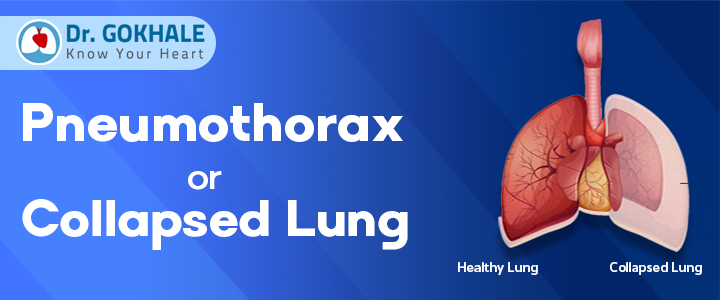 what is pneumothorax or collapsed lung dr gokhale