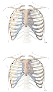 Small incisions on the side of chest for minimal access mitral valve replacement or repair