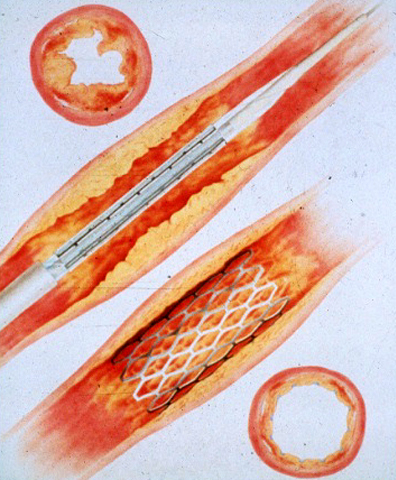 Angioplasty Stent Placement Procedure