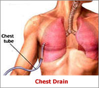 chest tube insertion image