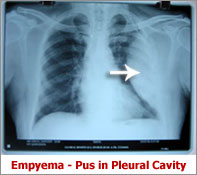 empyema pus in pleural cavity