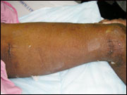 Endoscopic Vein Harvesting endoscopic vein harvesting