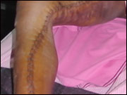 Endoscopic vein harvesting technique endoscopic vein harvesting technique