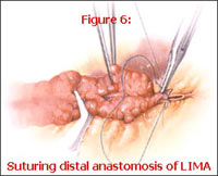 Suturing distal anastomosis of lima