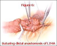 Suturing Distal Anastomosis of LIMA Suturing distal anastomosis of lima