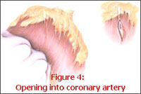 Location of Coronary Artery Openings location of coronary artery openings