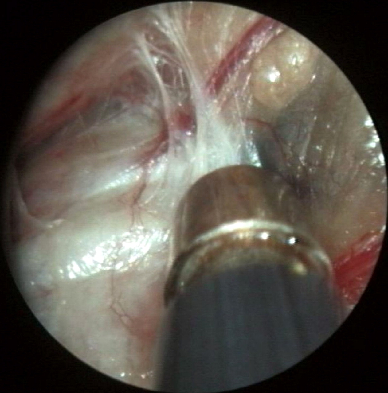 Mediastinoscopy Surgery