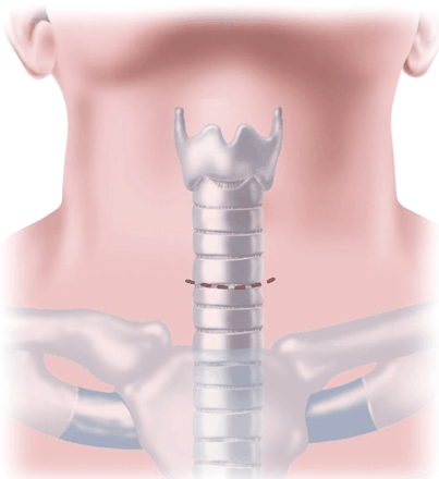 Mediastinoscopy surgical procedure Mediastinoscopy Surgical Procedure