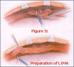 Preparation of LIMA Preparation of LIMA