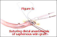 Suturing Distal Anastomosis Of Saphenous is Vein Graft suturing distal anastomosis of saphenous is vein graft