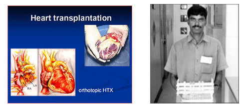 heart transplantation in hyderabad