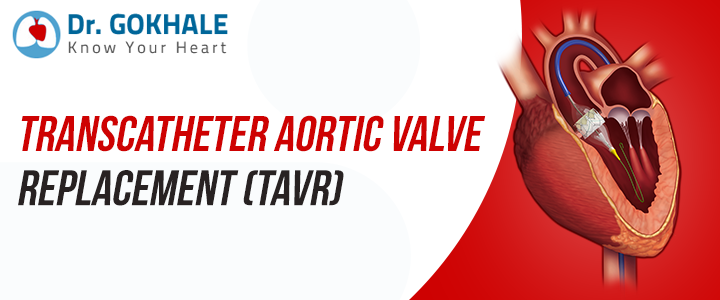 Transcatheter Aortic Valve Replacement (TAVR)