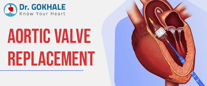 Aortic Valve Replacement | Dr Gokhale