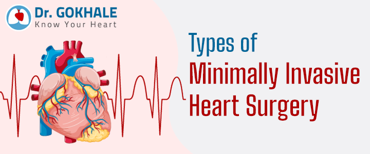 Types of Minimally Invasive Heart Surgery