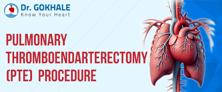 Pulmonary Thromboendarterectomy (PTE) Procedure