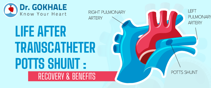 Life After Transcatheter Potts Shunt: Recovery and Benefits