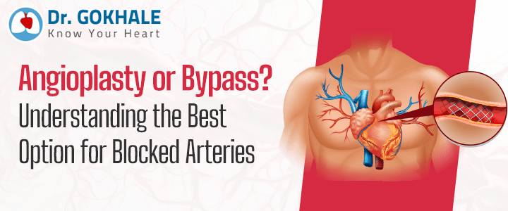 Angioplasty or Bypass? Understanding the Best Option for Blocked Arteries