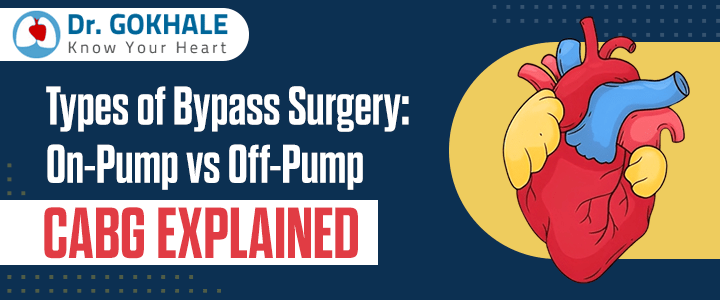 Types of Bypass Surgery: On-Pump vs Off-Pump CABG Explained