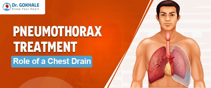 Pneumothorax Treatment: Role of a Chest Drain