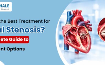 What Is the Best Treatment for Mitral Stenosis? A Complete Guide to Treatment Options